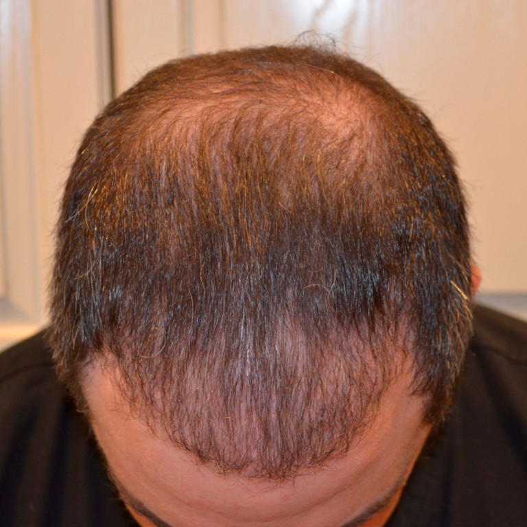 Помогите восстановить волосы. PRP кожи головы до и после. Волосы 5 мм на голове. Марафон восстановление волос.